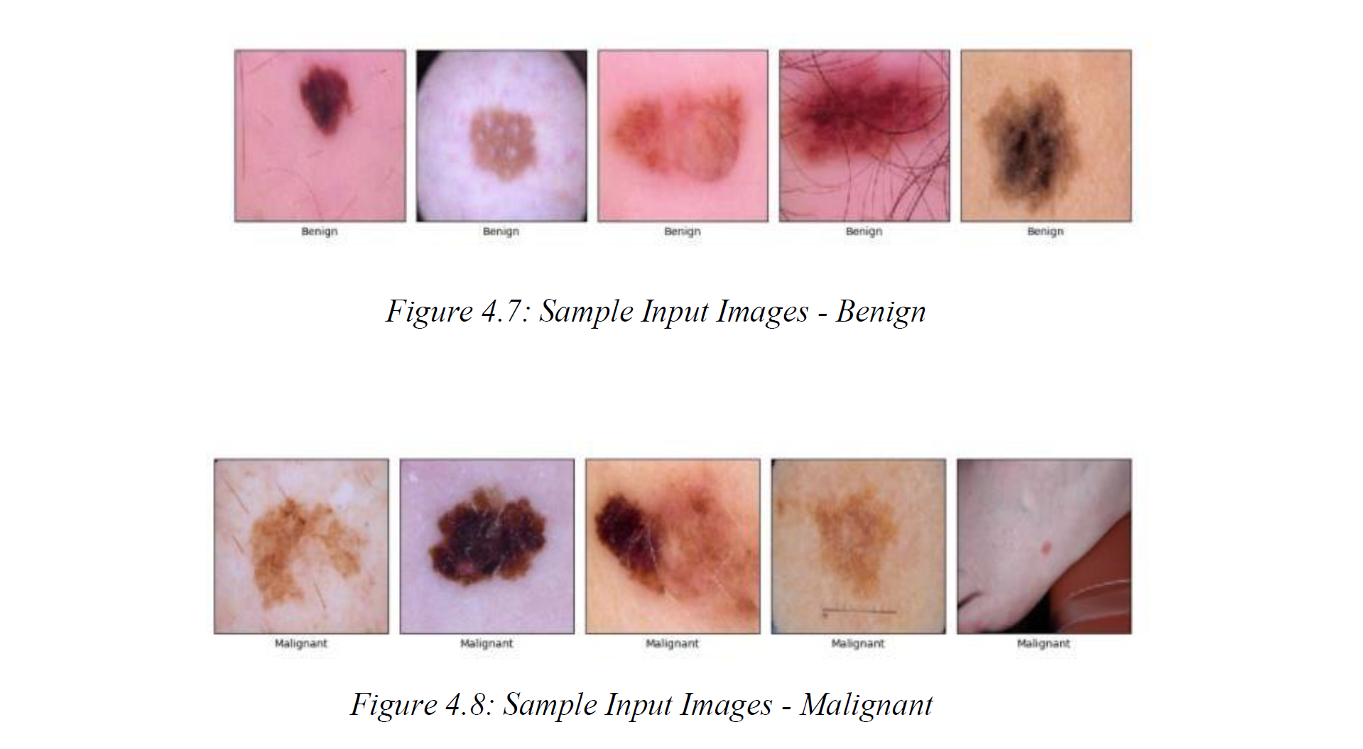 Skin Cancer Detection